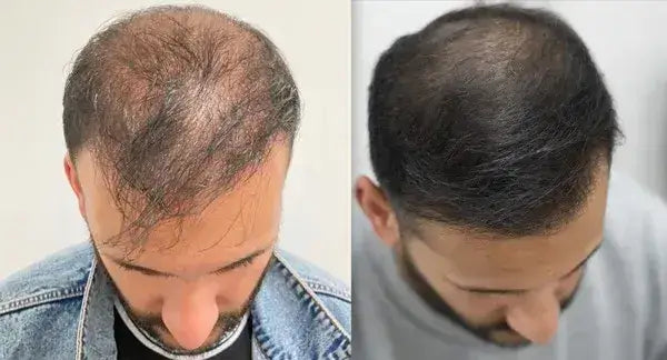 Resultado antes y después