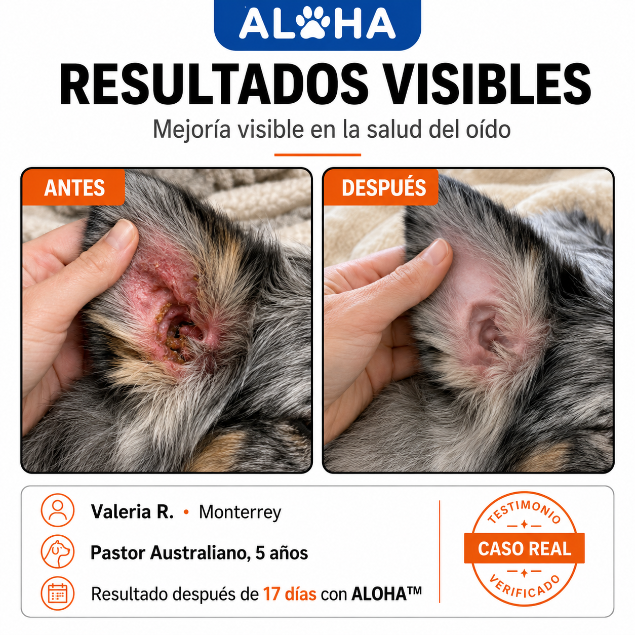 Infección por levadura